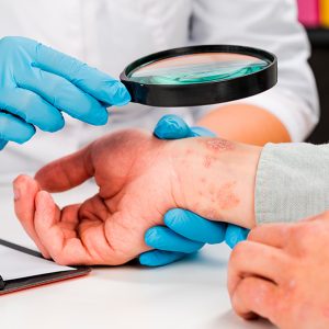 Psoriasis